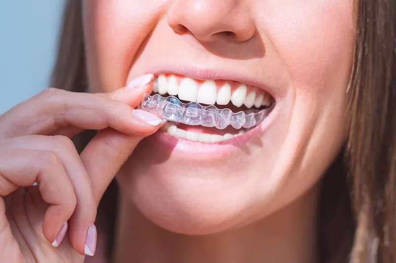 Invisalign Toronto, ON