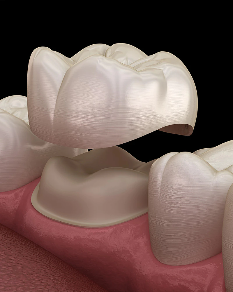 dental crowns Toronto, ON