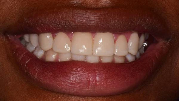 After image