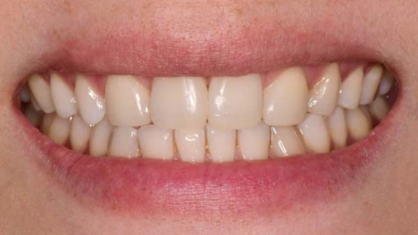 After image